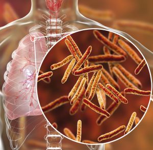 Methods for Using Gold (III) Compounds to Potentially Treat Tuberculosis (TB)